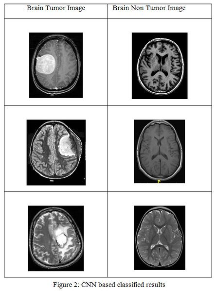 Файл:Brain tumor mri cnn.jpg